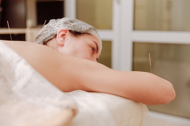Top 10 Advantages of Acupuncture